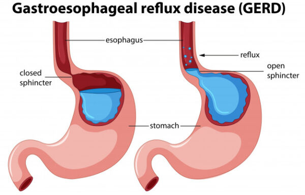 Laparoscopic Nissen Fundoplication fot GERD – ELSA